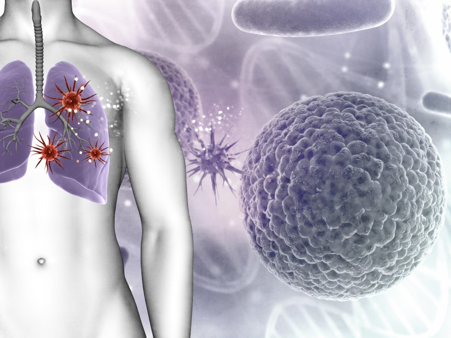 Lung cancer - Doxorubicin Chemoembolization For Hepatocellular Carcinoma