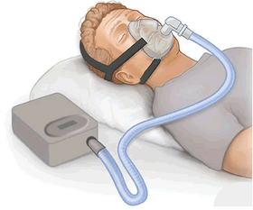 CPAP Therapy for Sleep Apnea