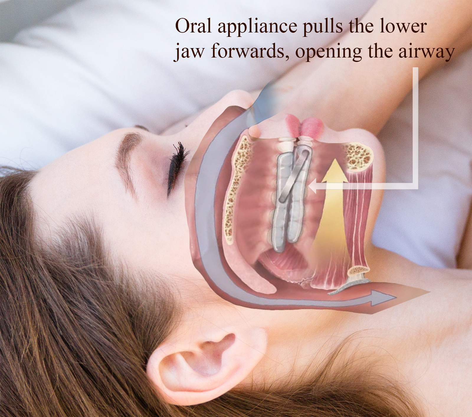 Oral Appliances Therapy in Sleep Apnea