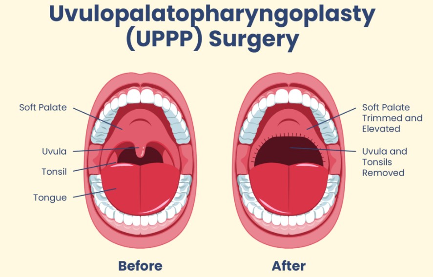 Uvulopalatopharyngoplasty (UPPP)